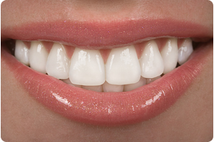 Dental Veneers From Homewood I L Favorite Dentists