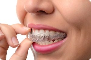 Invisalign Dentist In Flossmoor iL