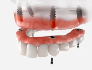 Dentures That Don't Move in Flossmoor, IL